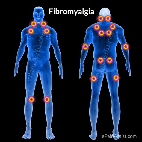 fibromyalgia icd 10
